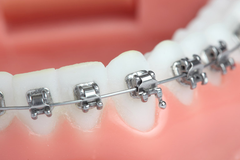 aparelho-fixo-autoligado-ortodontia