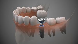 melhor clinica de implante dentário em fortaleza